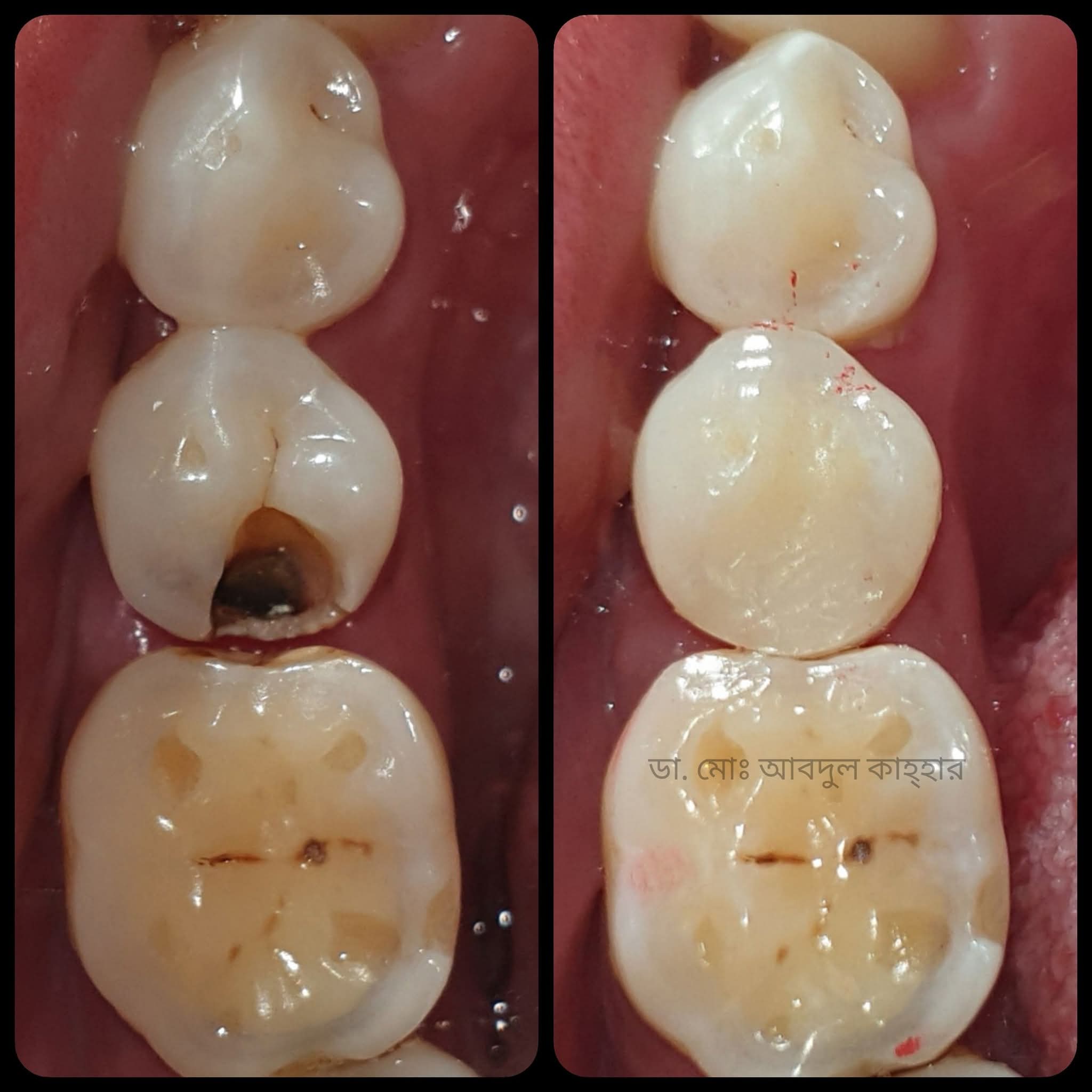 After treatment - কসমেটিক ফিলিং