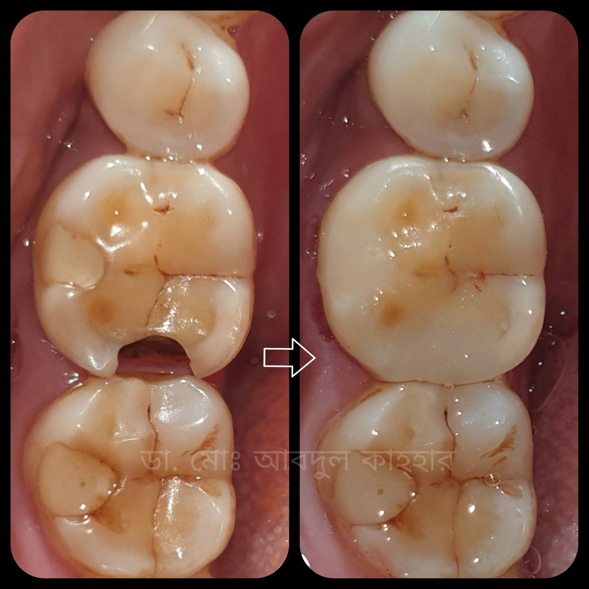 Before treatment - কসমেটিক ফিলিং